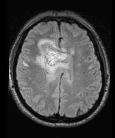 glioblastoma idh wild type grade 4